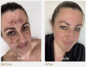 Skin Conditions - Nude Skin and Beauty Nude Skin and Beauty | Dunedin